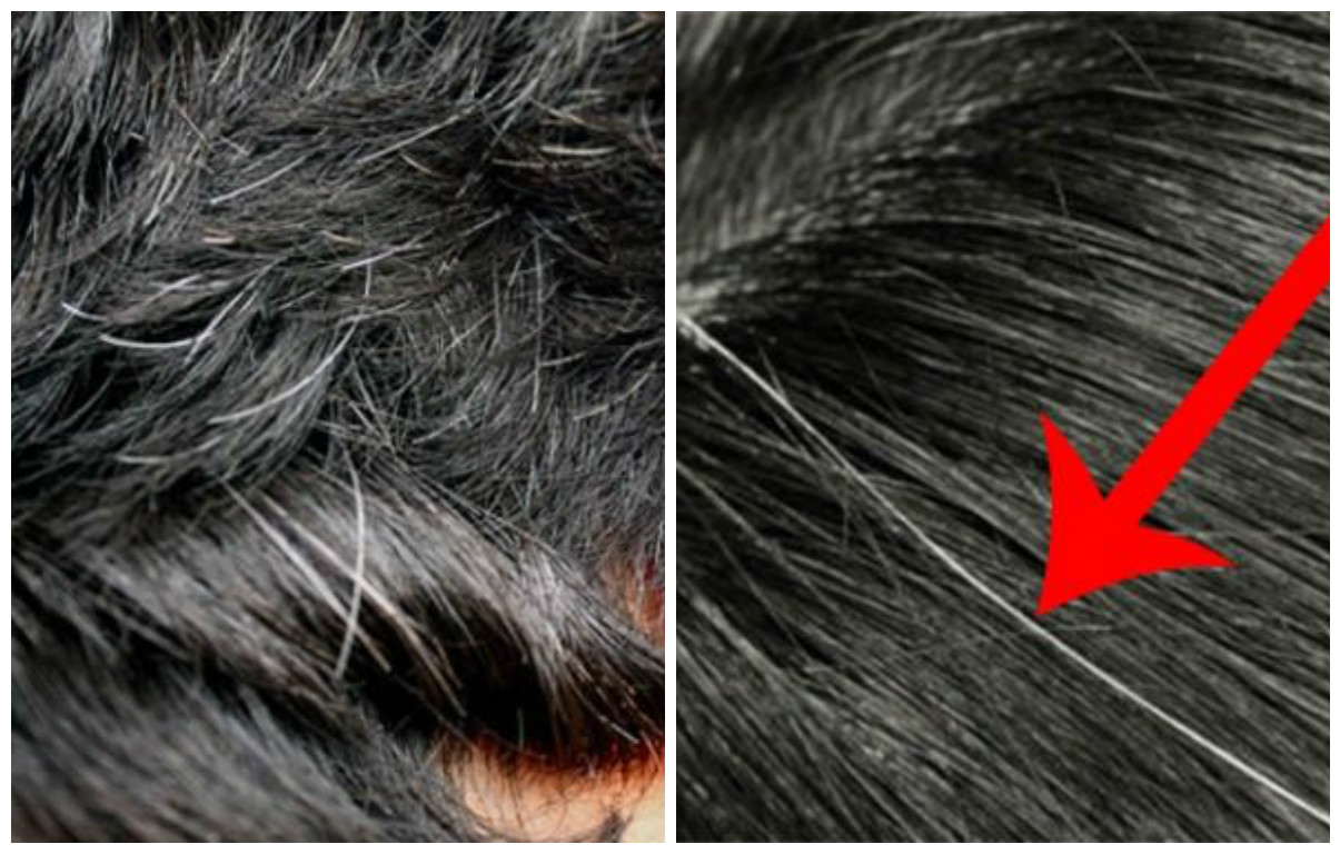 Les cheveux blancs qui poussent avant que l’on ait atteint la quarantaine est alarmant. Des cheveux gris en revanche sont tout à fait en cohérence avec le processus de vieillissement.Cependant, avoir une majorité de cheveux gris à 30 ans indique peut-être le diabète. Le diabète trouble le fonctionnement des mélanocytes, les cellules produisant la mélanine et déterminant la couleur des cheveux.